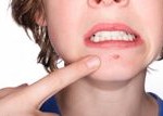 Don’t let acne put you down